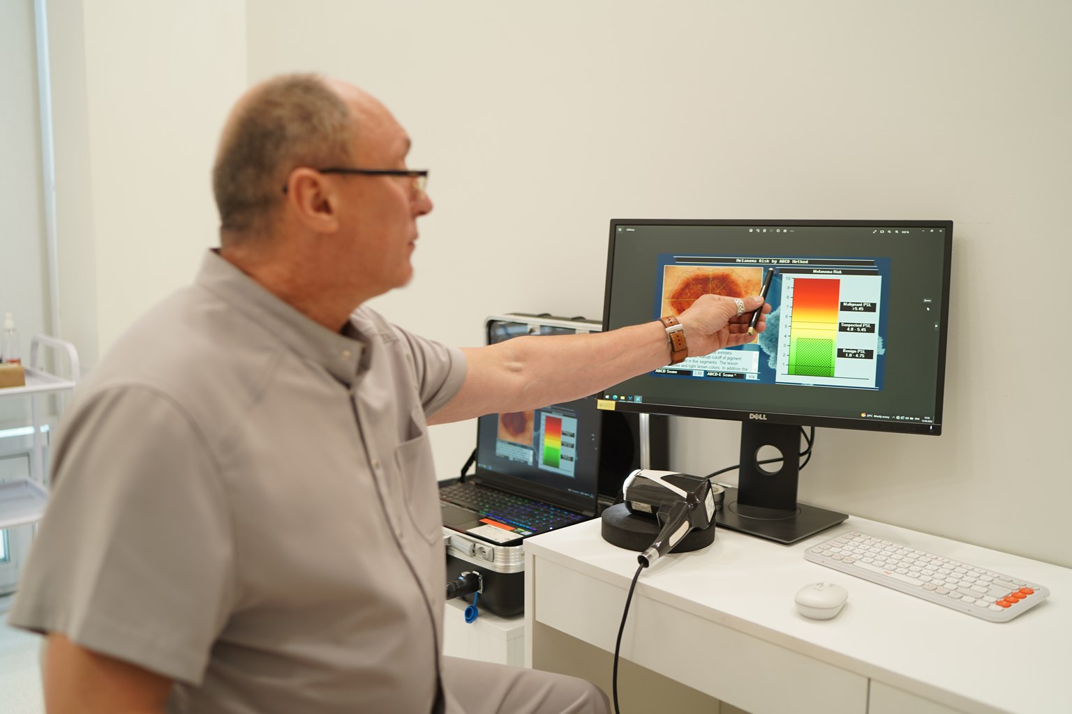 Early Stage Melanoma: 5 Signs Only a Dermatoscope Can See
